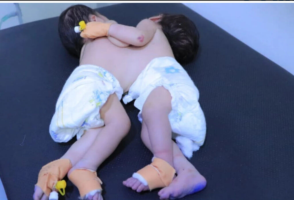 The Yemeni Health Ministry holds Saudi Arabia and complicit international organizations responsible for the death of a conjoined twin